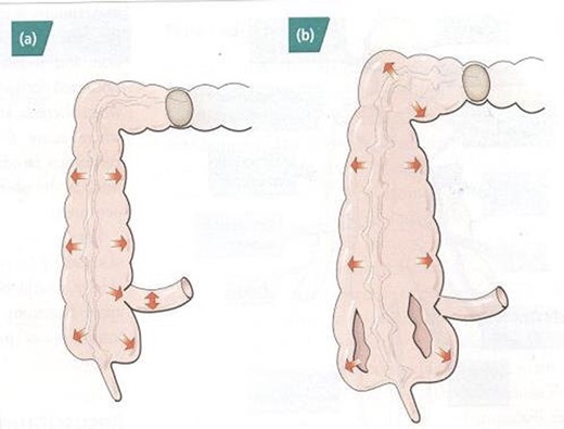 Laplace Law taking effect in distal colonic obstruction.