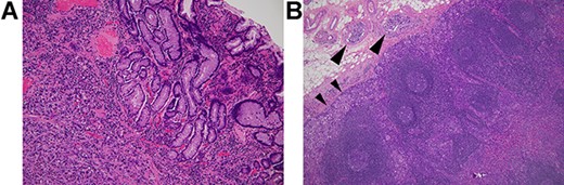 Histology of the primary gastric cancer. (A) Note that highly atypical tumour cells diffusely invade the stomach wall beneath the lamina muscularis mucosae (HE, ×100). (B) Lymph node metastasis (subpyloric node). Note cancer invasion in the peripheral cortex (smaller arrowheads) and afferent lymphoid vessels (larger arrowheads) (HE, ×100). The lymphatic invasion seen here is morphologically similar to those in the appendix vermiformis wall.