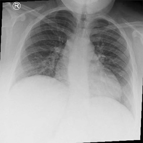 Normal chest X-ray with levocardia.