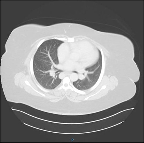 CT chest showing normal anatomy of the heart and lungs.