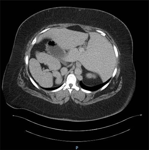CT abdomen showing reversal of intra-abdominal organs with polysplenia.