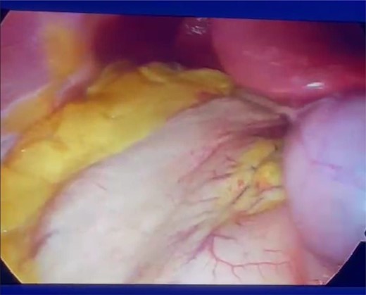 Intra-abdominal exploration showing stomach on the right side of patient.