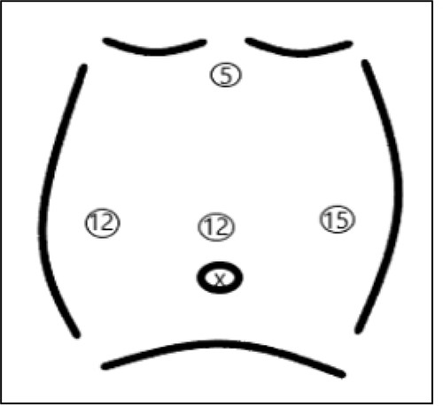 Trochars position.