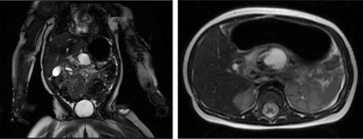 MRI images from initial upper GI bleed presentation.
