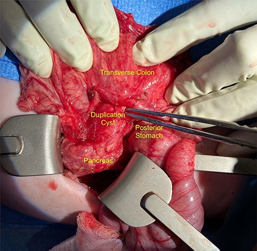 Intraoperative image showing the duplication cyst in relation to surrounding organs, and the inflammatory tissue extending from the mass to the colon (at the tip of the forceps).