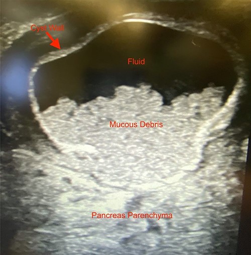 Intraoperative ultrasound image revealing a thick-walled mass intimately associated with the pancreas filled with fluid and mucous debris.