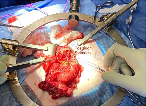 Cystgastrostomy formation after mucosectomy.