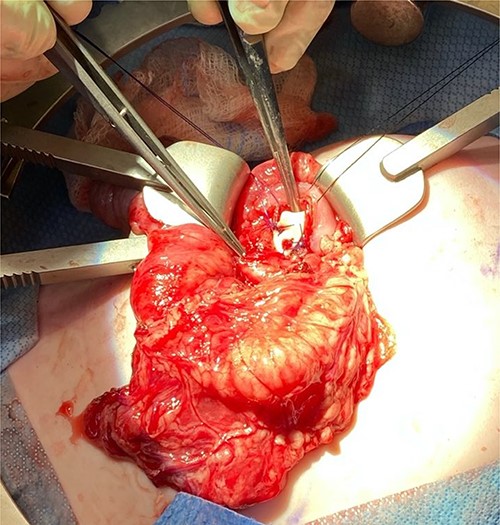 Penrose drain fixed across the cystgastrostomy with PDS sutures.