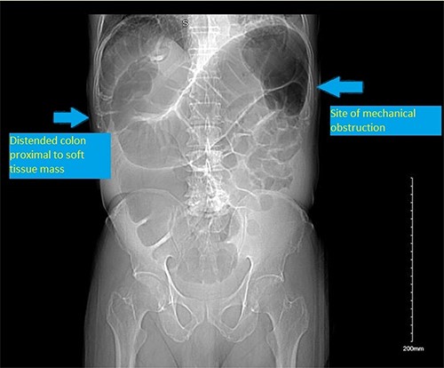 CT scan scout showing distended colon proximal to a soft tissue mass/ shadow at the splenic flexure.
