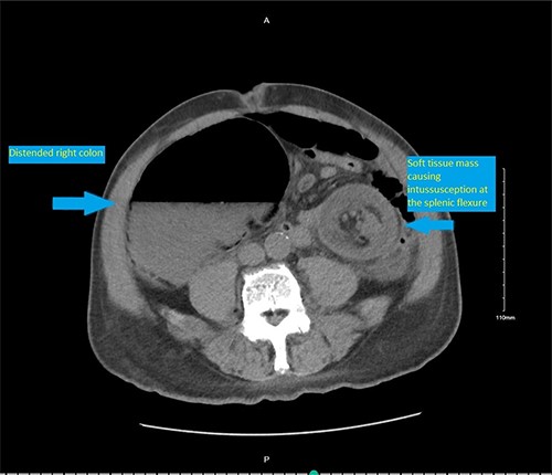 CT scan pelvis (axial cut) showing a soft tissue lesion in the left colon, with surrounding fat stranding and distended right colon.