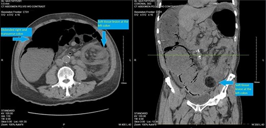CT scan pelvis (axial and coronal cuts) showing a soft tissue lesion in the left colon, with surrounding fat stranding and distended right and transverse colon.