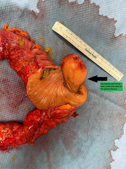 The left hemicolectomy specimen opened to show the intraluminal lipomatous lesion causing the mechanical obstruction at the splenic flexure.