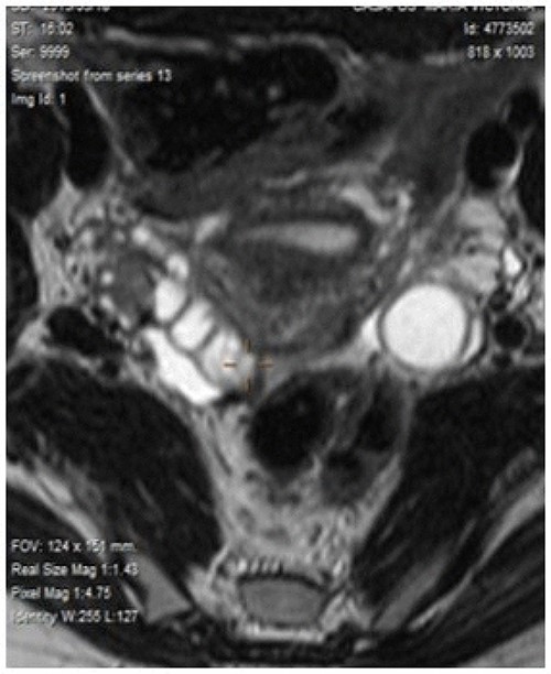 Magnetic resonance detected adenopathy in the aortoiliac bifurcation of undetermined origin, and a lesion in the right annex, which could correspond to a neoplastic process linked to endometrioma of the right ovary or to a tubal origin.