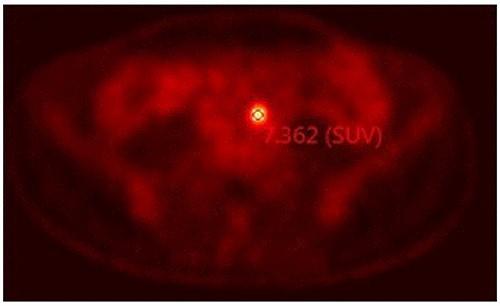 PET-CT scan informed adenopathy in the aortoiliac bifurcation (SUV 7.3).