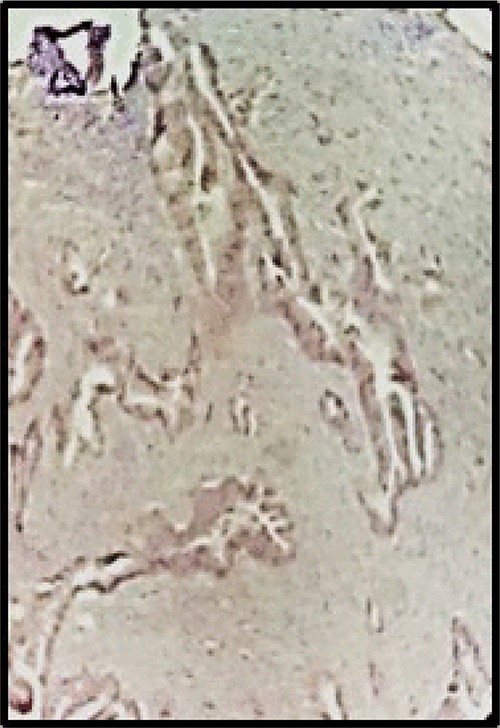 Immunohistochemistry: CK7, CA 125 and WT1 were negative, (HE 40X).