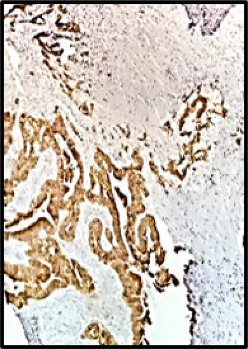 Immunohistochemistry: CK20 was positive, intense and diffuse (HE 40X).