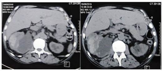 The CT scan showed a huge subcapsular hematoma (12 × 14 × 10 cm) of the right kidney.