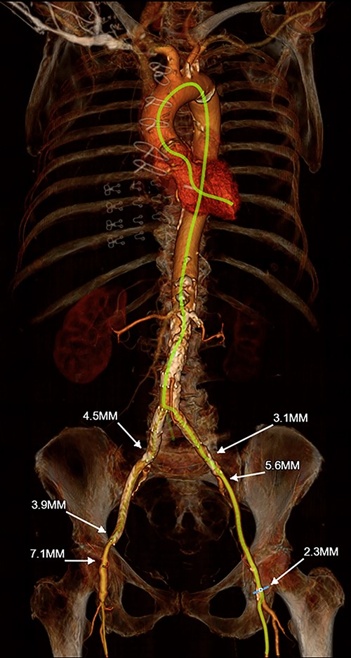 3-D reconstruction of Patient #1’s TAVR CT angiogram of the chest, abdomen and pelvis demonstrating prohibitively small iliofemoral arterial anatomy and heavily diseased bilateral subclavian arteries; the innominate artery is of normal caliber and is minimally diseased.