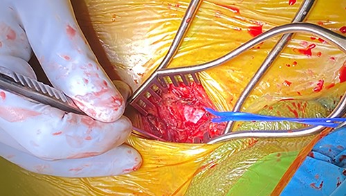 Intra-operative photo illustrating the longitudinal incision overtop the medial aspect of the right sternocleidomastoid muscle; the blue vessel loop is encircled around the innominate artery.