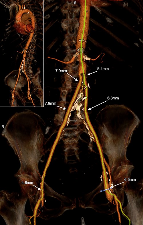 3-D reconstruction of Patient #2’s TAVR CT angiogram of the chest, abdomen and pelvis demonstrating hostile peripheral arterial anatomy, including an aortobifemoral bypass; the innominate artery is of normal caliber and is minimally diseased.
