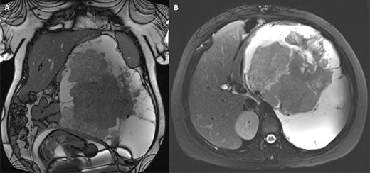 MRI surveillance scan 6 months after diagnosis at 33 weeks of gestation; the tumour and gravid uterus are evident in the coronal view (A), and the tumour occupies the whole left upper quadrant in the axial view (B).