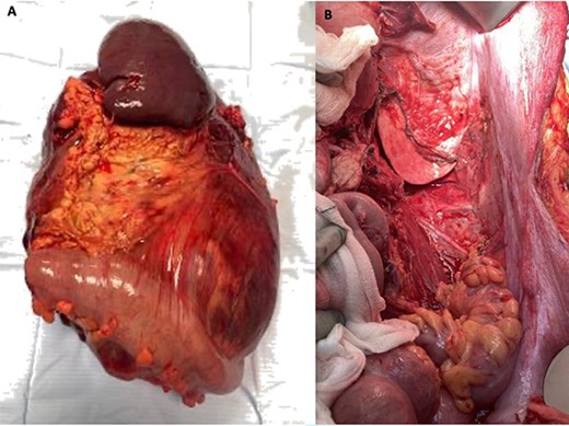 Peri-operative images showing (A) fresh specimen from multivisceral resection with spleen, pancreas and colon clearly visible, and (B) operative field after resection.