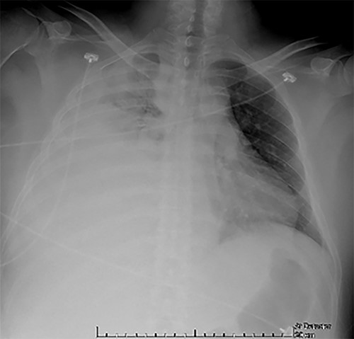 CXR at admission: right pleural effusion occupying 90% of the lung.