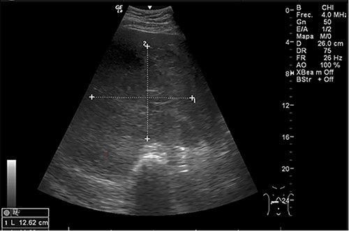 Abdominal US at admission: nodular lesion in the right liver lobe.