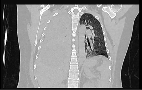 Frontal chest CT at admission: right pleural effusion occupying 100% of the lung.