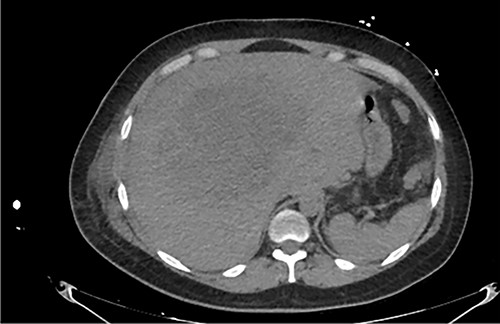 Axial abdominal CT at admission: 20 cm nodular lesion occupying the right liver lobe.