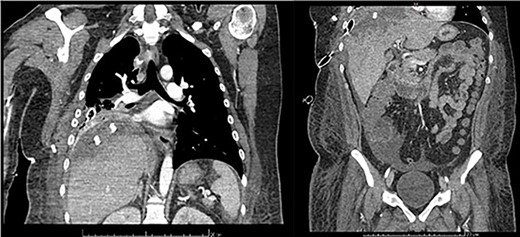 Frontal thoraco-abdominopelvic CT at 9 days after surgery: subpleural collection of 79 × 34 mm, heterogenous, hypodense hepatic lesion with contrast enhancement on its borders, fluid collection around the liver, paracolic gutters and pelvic cavity.