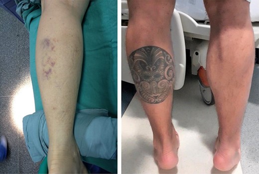 Clinical images of Patient 1 and Patient 2, respectively. In the left image, we observe the presence of posterior ecchymosis on the calf. In the right image, we observe medial muscle space in the left calf associated with significant varus of the hindfoot, previously absent, ipsilateral to the lesion.
