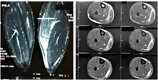 MRI images of Patient 1 and Patient 2, respectively. In the left image, a coronal section of the two legs weighted in a sensitive liquid sequence shows edema accompanied by a distal gap in the lesion topography. In the right image, we see multiple axial slices also showing fluid accumulation and muscle retraction in the musculotendinous transition.