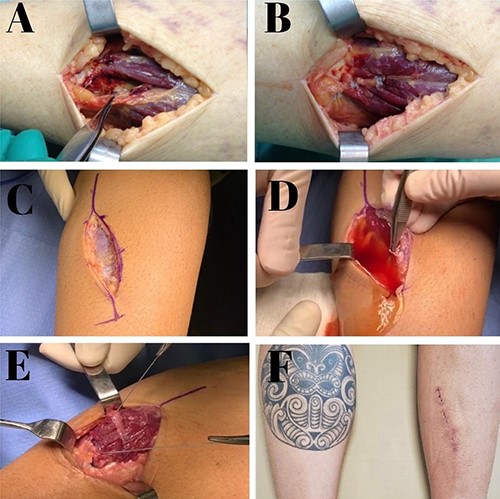 Intraoperative images of Patient 1 (A, B); intraoperative and postoperative images of Patient 2 (C–F). (A) Image of a complete gastrocnemius muscle medial head lesion with large gap; (B) suture and complete closure; (C) posteromedial incision above the lesion; (D) abundant outflow of fluid collection after identification of muscle rupture; (E) lesion sutures with total repair of the myotendinous part; (F) aspect of the incision at 3 weeks postoperatively.
