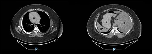 Computed tomography scan of the abdomen in our patient with SIT showing dextrocardia (H), spleen (SP) and stomach (S) located on the right side and liver (L) on the left side.