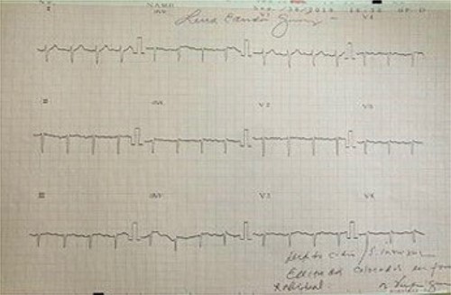 Electrocardiogram in dextrocardia; axis deviation to the right; positive QRS complexes (with positive P and T waves) in aVR; lead I: inversion of all complexes (inverted P wave, negative QRS, inverted T wave).