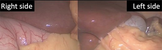 The lesser curvature of the stomach to the right of the falciform ligament, and the gallbladder located in the left upper quadrant.