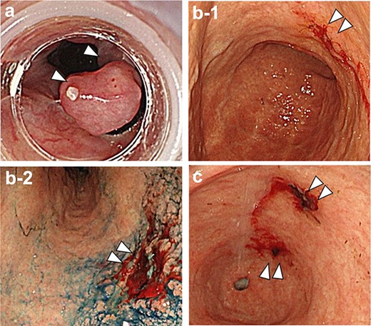 (a) Red color sign positive esophageal varices with white thrombus; (b-1.2) the gastric mucosa showed evidence of Helicobacter pylori current infection, and there was a 0-IIc lesion with exudative hemorrhage in the lesser curvature of the lower gastric body; (c) 0-IIc lesions were also observed on the anterior and posterior walls of the prepyloric region, respectively.