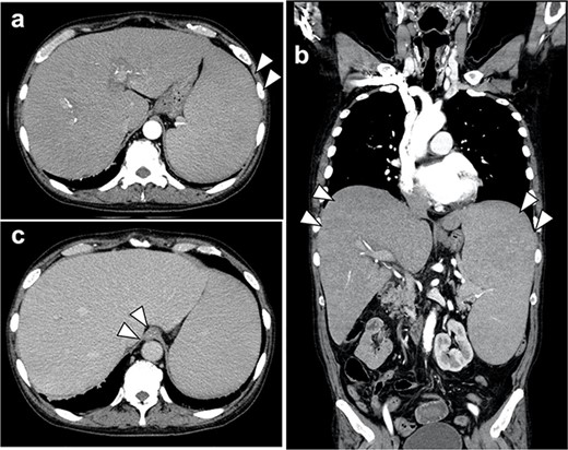 (a, b) Contrast-enhanced CT scan of the abdomen showed marked hepatosplenomegaly due to myelofibrosis; there was no extravasation of contrast medium into the gastroesophagus; no gastric cancer lesion could be identified; (c) the accumulation of contrast media in the lower esophageal wall of the esophagus was observed in the late contrast phase, which was varicose veins.
