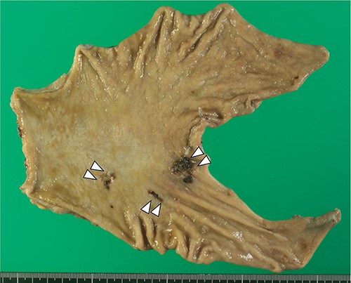 Macroscopically, 0-IIc lesions were found in the lesser curvature of the lower gastric body, and the anterior and posterior walls of the prepyloric region, respectively.