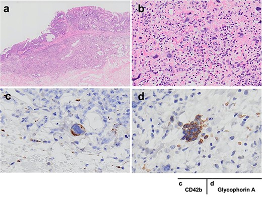 a, b and c, d show HE and immunostaining findings, respectively; (a) the three lesions in the stomach were all intramucosal adenocarcinoma (well different type, moderately differenced type); in the submucosa of the lower gastric body cancer, there were large nuclei, multinucleated atypical cells and small cells that were distinctly different from intramucosal cancer cells; (b) congregation of large nuclei, multinucleated cells and small cells was observed near the tumor cells; (c, d) the dysmorphic cells were positive for CD42b and the small cells were positive for glycophorin A; the cells were judged to be megakaryocytes and erythroblast islets, respectively.