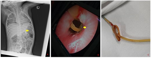 Knotted NGT as seen on a plain radiograph (A), endoscopy (B) and after removal (C).