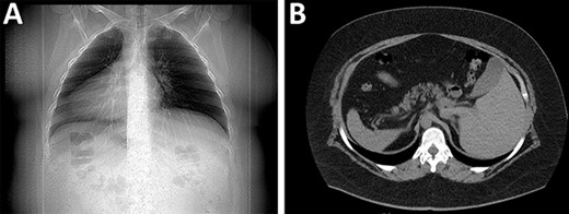 (A) X-rays with the organs in an inverted position. (B) CT revealing the spleen and liver in opposite places.