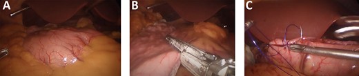 (A) Laparoscopy, showing the inverted position of intra-abdominal organs. (B) Stapling done on the stomach. (C) Buttressing suturing over the staple line.