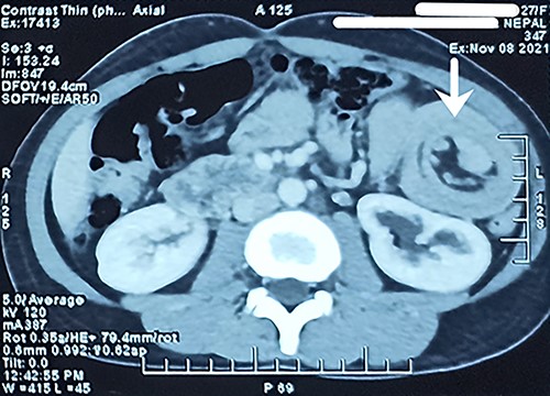 Long segment invagination of proximal jejunal loop into lumen of immediate distal jejunum.