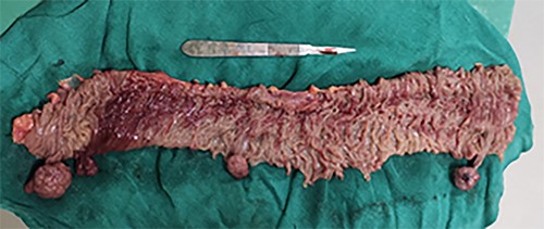 Resected segment of bowel with four polyps.