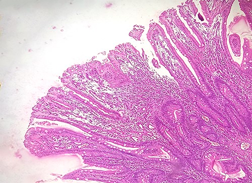 The polypoidal structures from the resected segment of the bowel were lined by intact columnar epithelium and consisted of villi and tubules (tubulovillous adenoma).