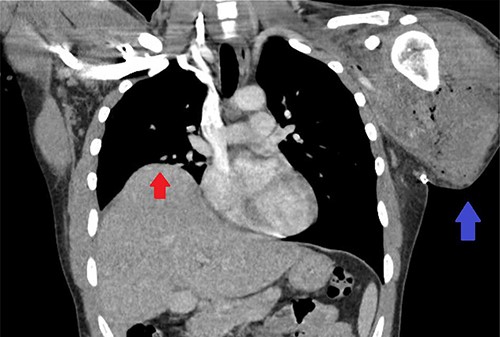 CT scan of the chest showing right-sided elevation/eventration of the diaphragm concerning for phrenic nerve injury (Red arrow); post-operative changes to LUE stump (Blue arrow).