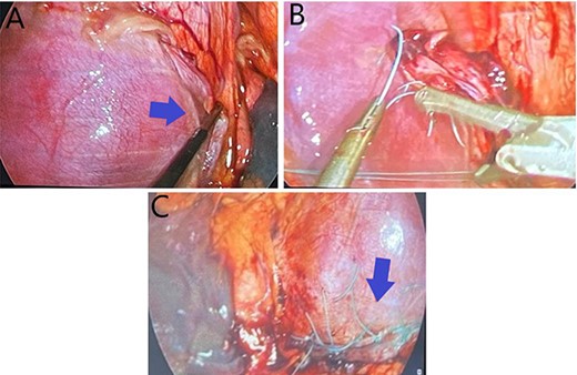 (A) Demonstrates a right hemi-diaphragmatic injury; (B) Depicts thoracoscopic suturing of the diaphragmatic defect; (C) shows completed thoracoscopic repair of the diaphragmatic injury.