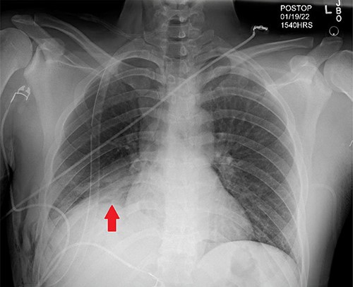 Post-operative CXR demonstrating appropriate placement of a thoracoscopic tube and improvement of right-hemi-thorax eventration (Red arrow).